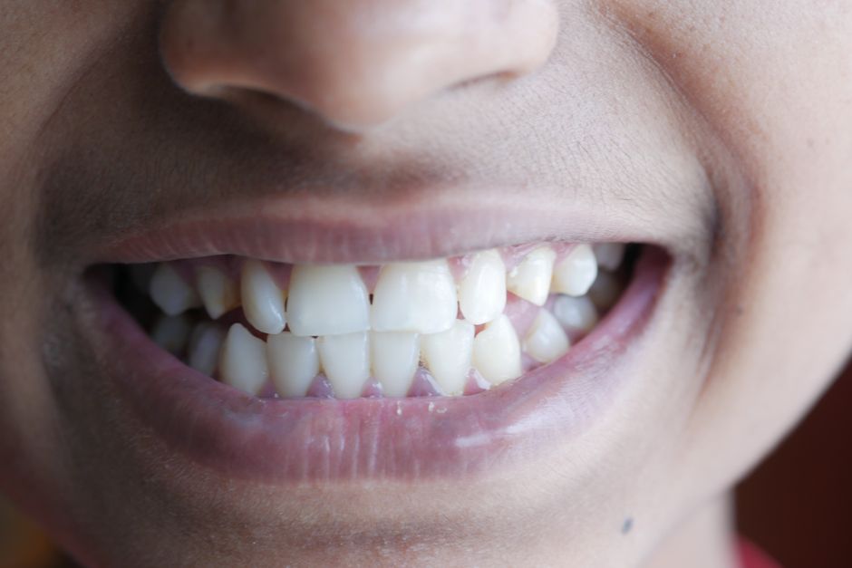 Sorriso sano e denti bianchi dopo un trattamento estetico dentale